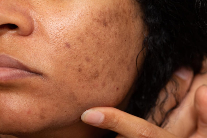 Black, pesky spots on the skin are often a beauty problem. They